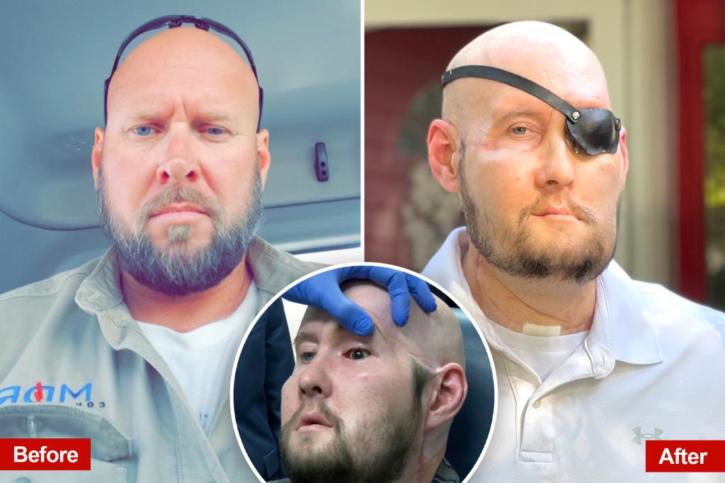 World's first full eye and partial face transplant patient adjusting to new normal, 1 year after landmark surgery: 'Second chance'